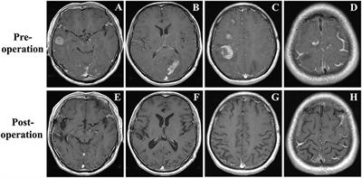 Case Report: Primary Indolent Epstein-Barr Virus-Positive T-Cell Lymphoproliferative Disease Involving the Central Nervous System